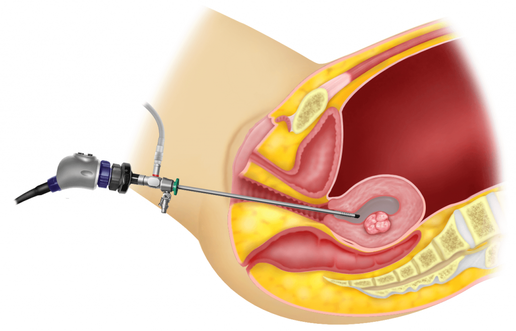 Safe and Reliable Healthcare at Ace Medicare for Hysteroscopy